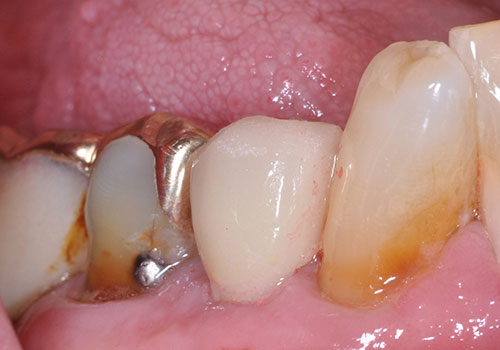 health centered dentistry midland tx services dental implants after