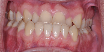 health centered dentistry midland tx services six month smiles before